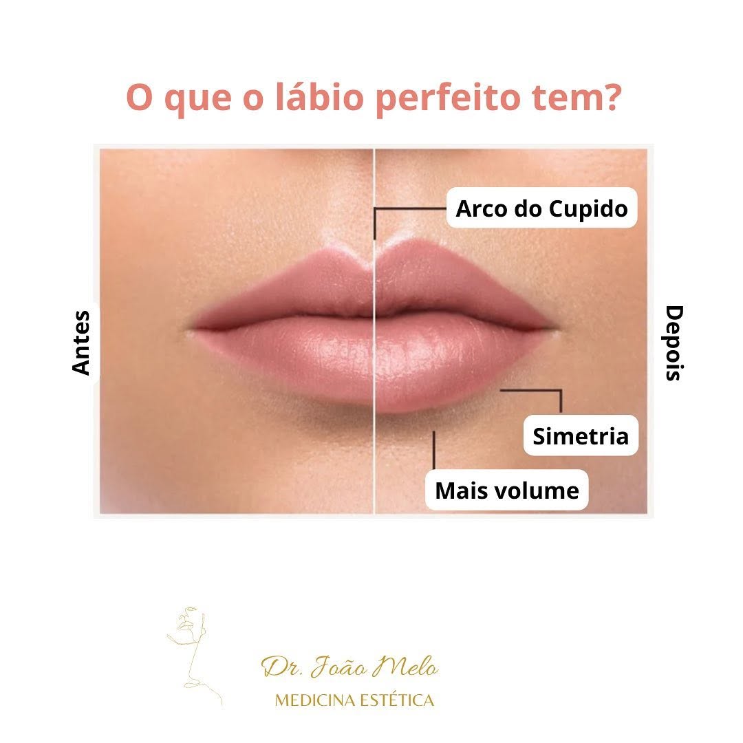 Preenchimento labial